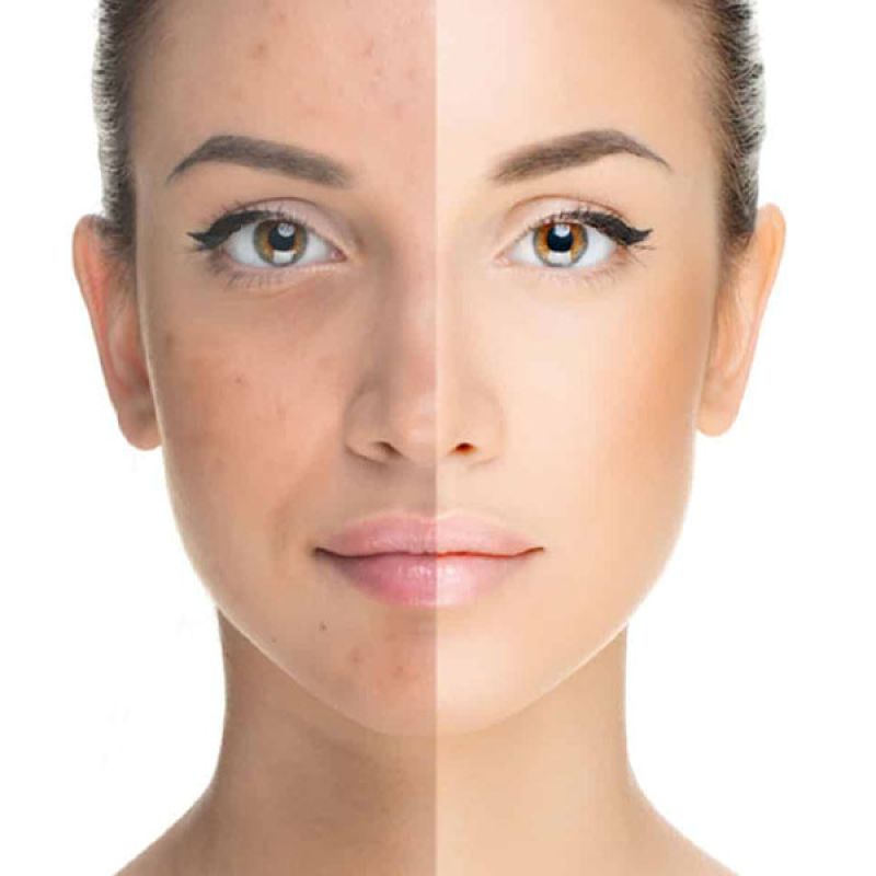 Acne Care