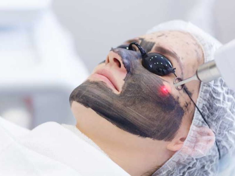 Hollywood Laser Peel