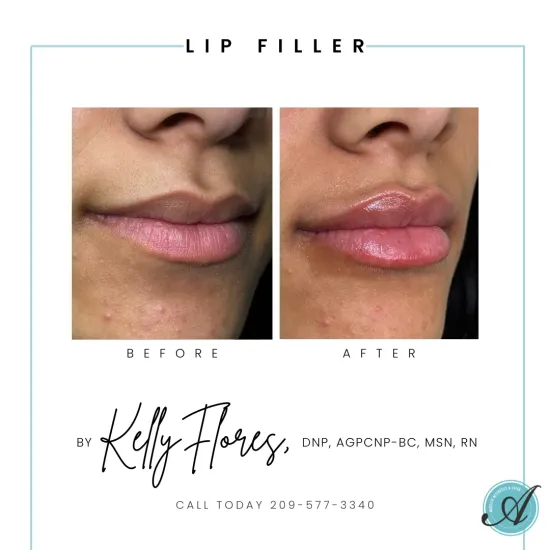 Lip Filler