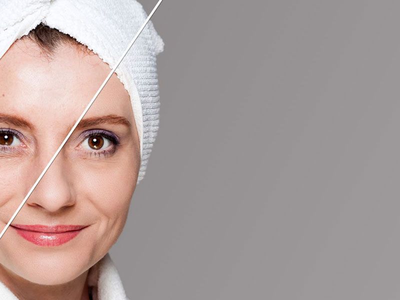 PRP/Microneedling