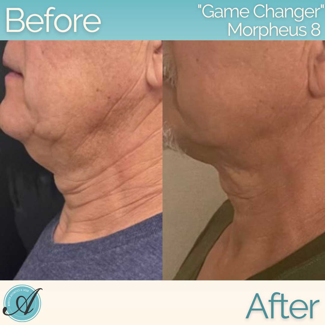 Morpheus 8 before and after.