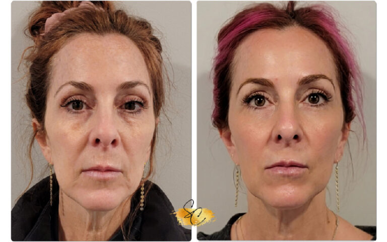 NeoGen PSR - Modesto Aesthetics & Laser