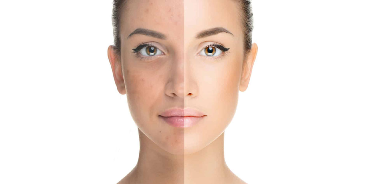 Before and after acne treatment.