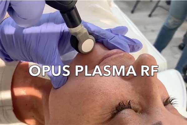 Opus Plasma RF treatment in progress.